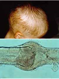 Information About Hair Shaft Defects