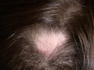 Alopecia Areata American Hair Research Society