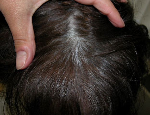 Female Pattern Hair Loss  Elinay Cosmetic Physicians Centre