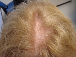 Female Pattern Baldness Causes and Treatment Options