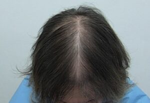 Can Hair Loss Be Reversible  PAI Hair Restoration McLean Virginia