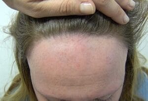 alopecia no cicatricial