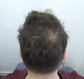 male pattern baldness crown