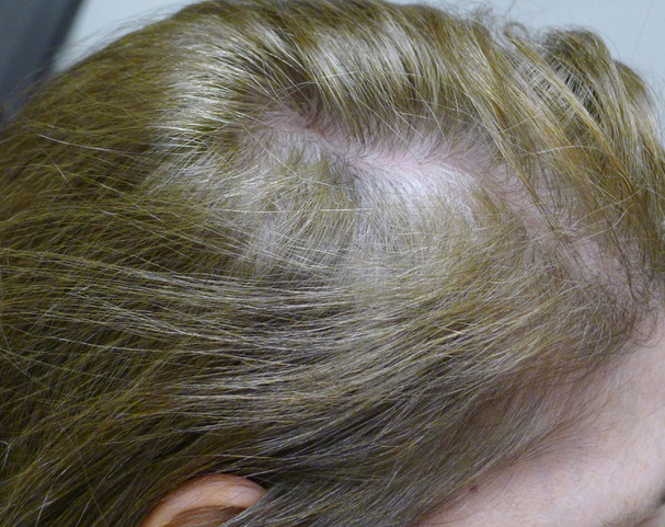Noninvasive method distinguishes chronic telogen effluvium from mild  female pattern hair loss clinicopathological correlation  Bittencourt   2016  International Journal of Dermatology  Wiley Online Library